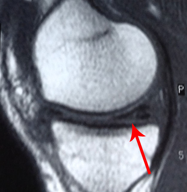 torn meniscus