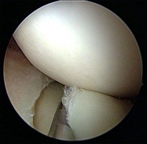 meniscus-2