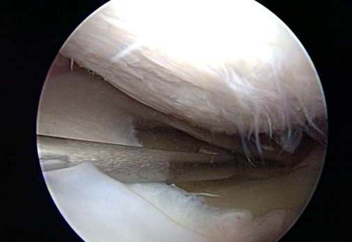 medial-miniscus