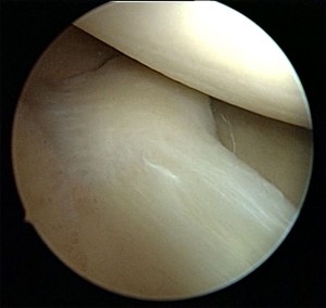 meniscus-3