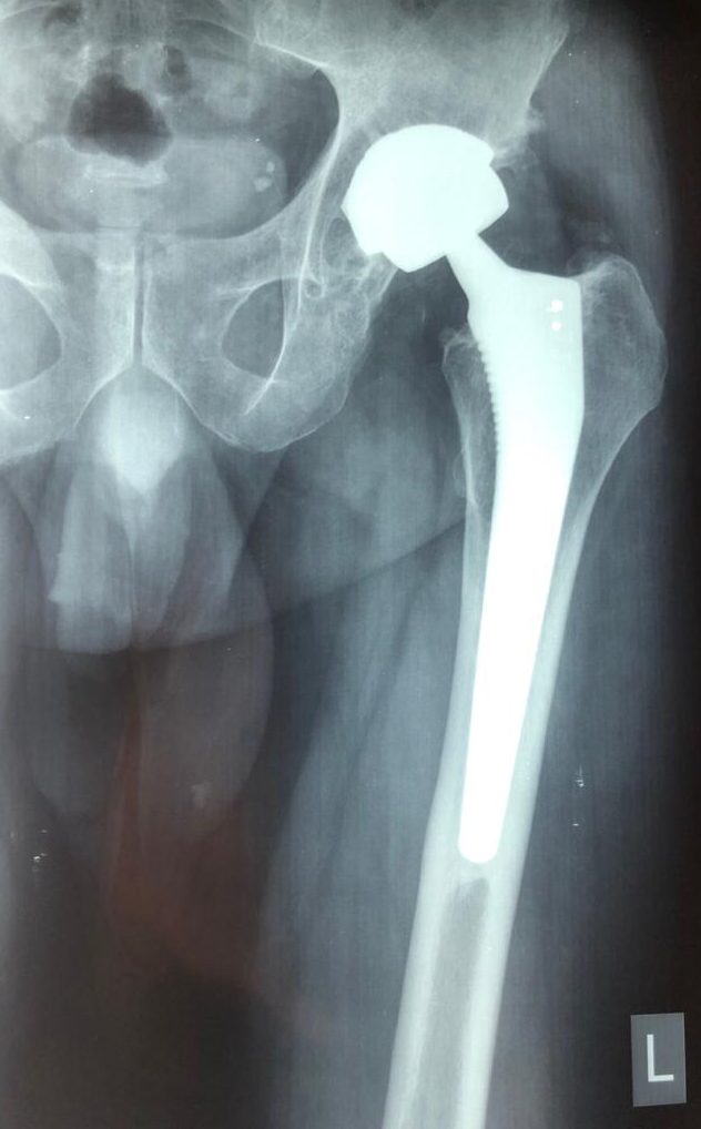 X-Ray image ap. THR LT. using the Dedienne Sante Implant with complete Boney healing 12 Years post OP